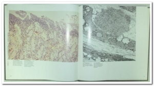 ATLAS OF DISEASES OF THE UPPER GASTROINTESTINAL TRACT, 3 VOLUMES